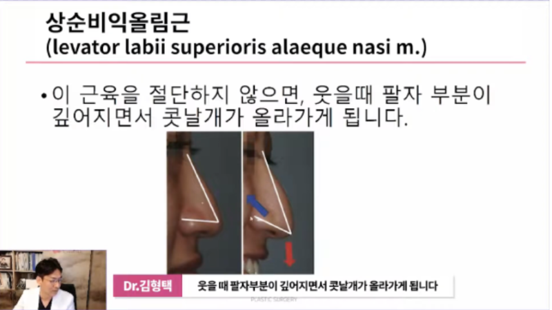 코끝처짐, 코끝근육교정으로 개선할 수 있습니다 사진 3