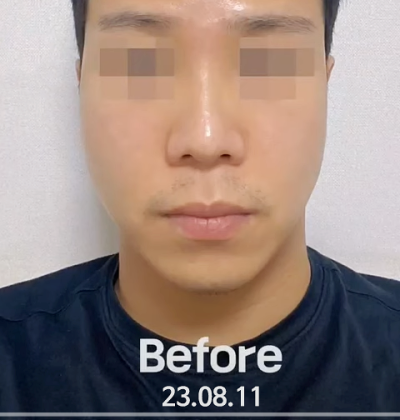 돌출입 코수술, 콧볼 축소 부담 줄이는 교정법 사진 11