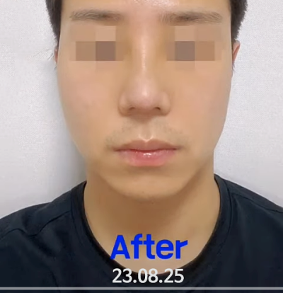 돌출입 코수술, 콧볼 축소 부담 줄이는 교정법 사진 12