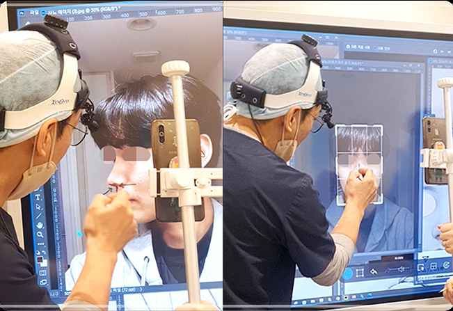 비순각 교정, 돌출입까지 해결 가능합니다 사진 8
