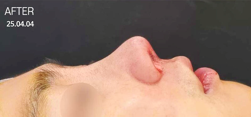 들창코수술 받기 전 확인해야할 중점 포인트 사진 6