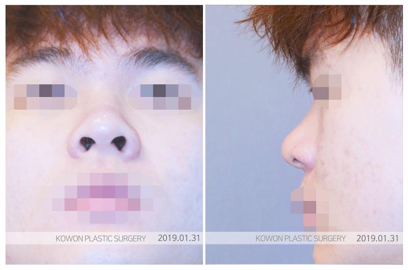 콧대수술, 더 아름다운 인상으로 변화시키는 방법은? 사진 3
