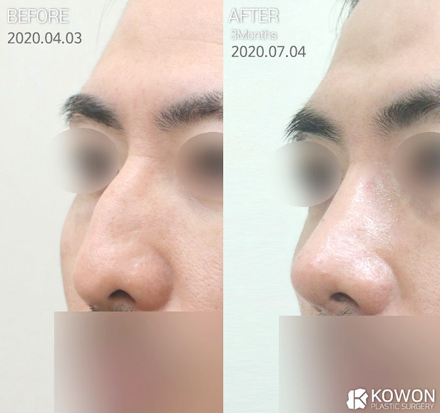 콧대수술, 더 아름다운 인상으로 변화시키는 방법은? 사진 4