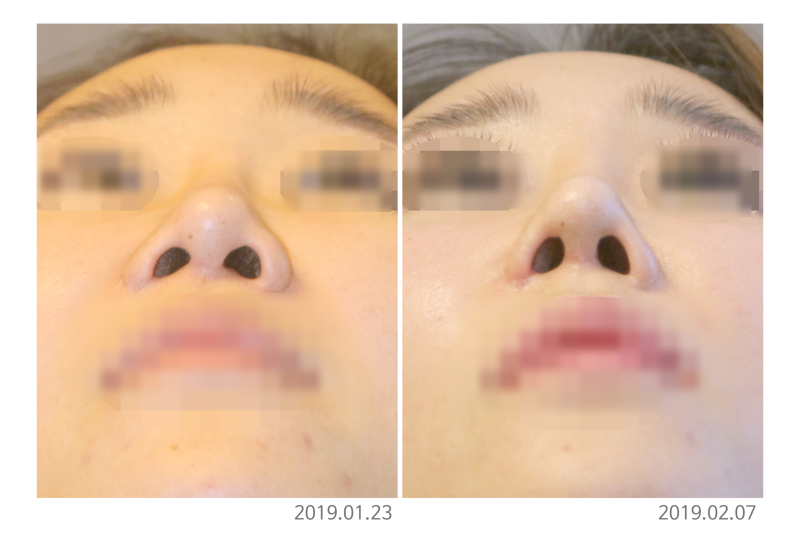 콧대수술, 더 아름다운 인상으로 변화시키는 방법은? 사진 5