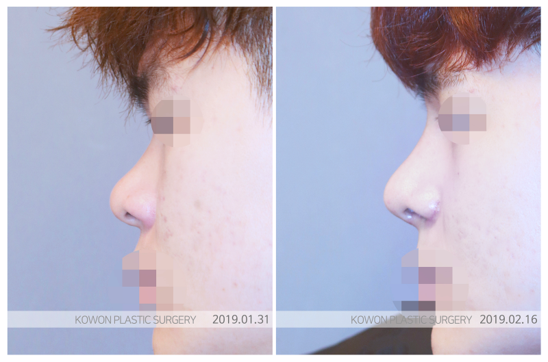 콧대수술, 더 아름다운 인상으로 변화시키는 방법은? 사진 6