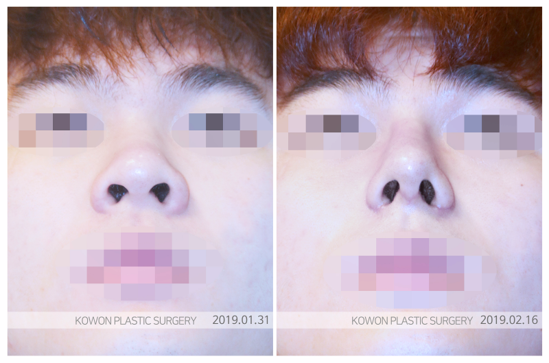 콧대수술, 더 아름다운 인상으로 변화시키는 방법은? 사진 7