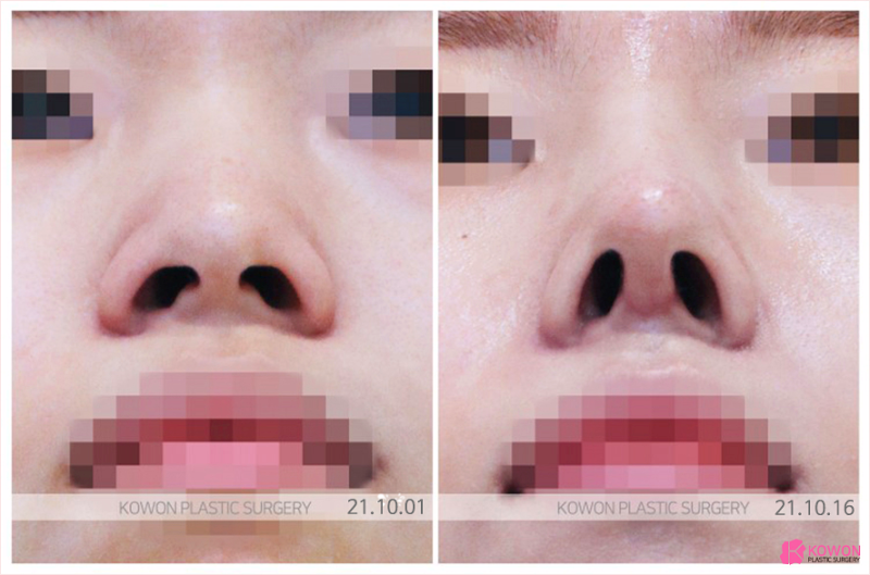 주먹코, 갑갑해 보이는 인상 탈출하고 싶다면? 사진 6