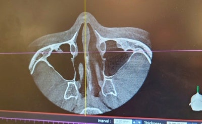 복코성형, 실패 줄이는 핵심 포인트 사진 7