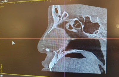 복코성형, 실패 줄이는 핵심 포인트 사진 6