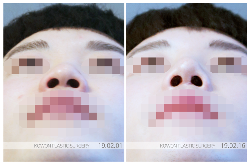 직선코, 사진보다 실물이 밋밋한 남성 필독 사진 7