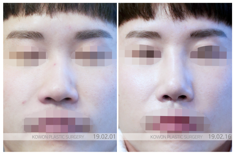 직선코, 사진보다 실물이 밋밋한 남성 필독 사진 5