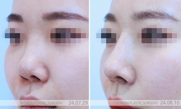 콧대높이기, 얼굴 조화 살리는 자연스러운 설계 사진 5