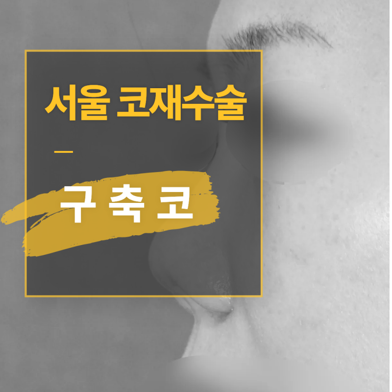 서울 코재수술, 구축코 복원 꼭 알아둘 점
