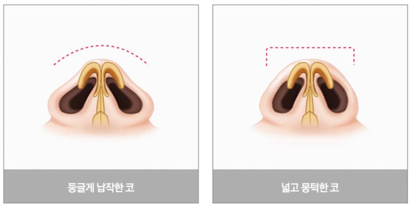 남자코수술 비용, 복코 형태에 따라 달라집니다