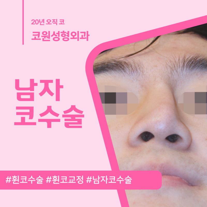 남자코수술, 휜코 때문에 비대칭된 인상 교정하기