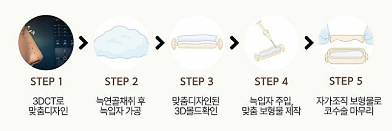 코수술잘하는곳, 선택 기준 알려 드립니다 사진 4