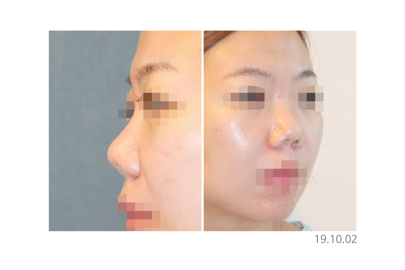 코성형외과유명한곳, 코재수술 결정 전 확인해야 할 포인트 사진 5