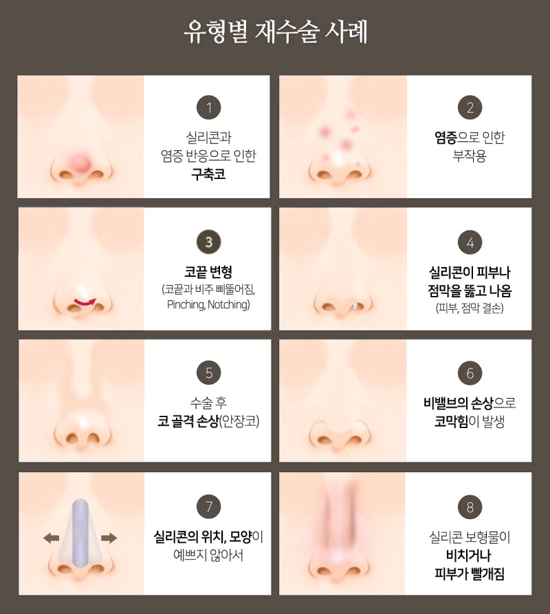코성형외과유명한곳, 코재수술 결정 전 확인해야 할 포인트 사진 3