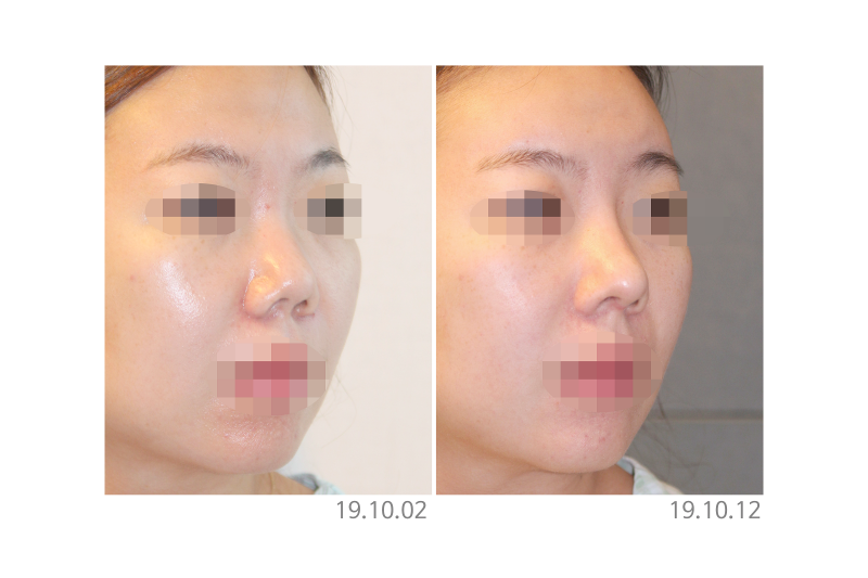 코성형외과유명한곳, 코재수술 결정 전 확인해야 할 포인트 사진 7