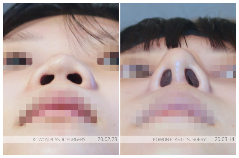 납작코, 보형물만으로 해결되지 않는 진짜 이유 사진 3
