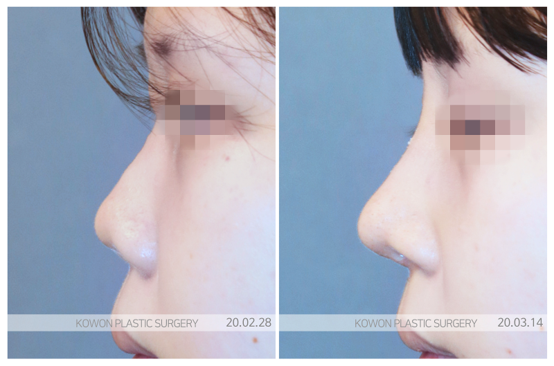 납작코, 보형물만으로 해결되지 않는 진짜 이유 사진 6