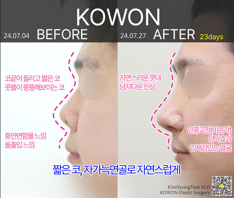 서울코성형외과, 돌출입처럼 보인다면 비순각부터 확인하세요 사진 5