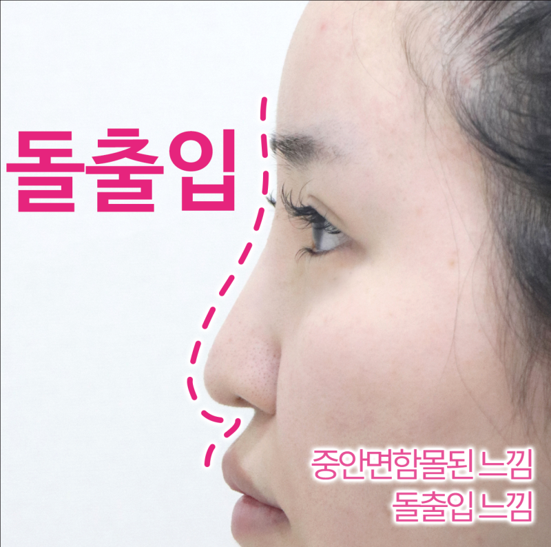 서울코성형외과, 돌출입처럼 보인다면 비순각부터 확인하세요