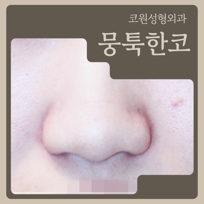뭉툭한코, 자연스럽게 개선하는 방법