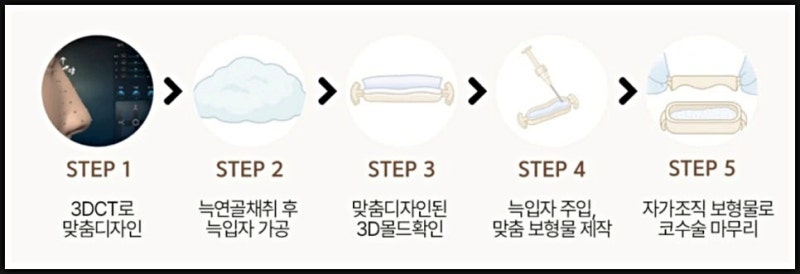 코끝 처짐, 화살코 코끝만 교정한다고 끝이 아닙니다 사진 7