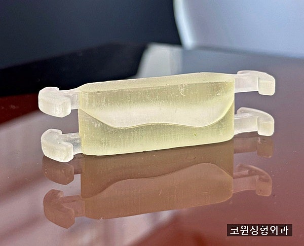 코끝 처짐, 화살코 코끝만 교정한다고 끝이 아닙니다 사진 6