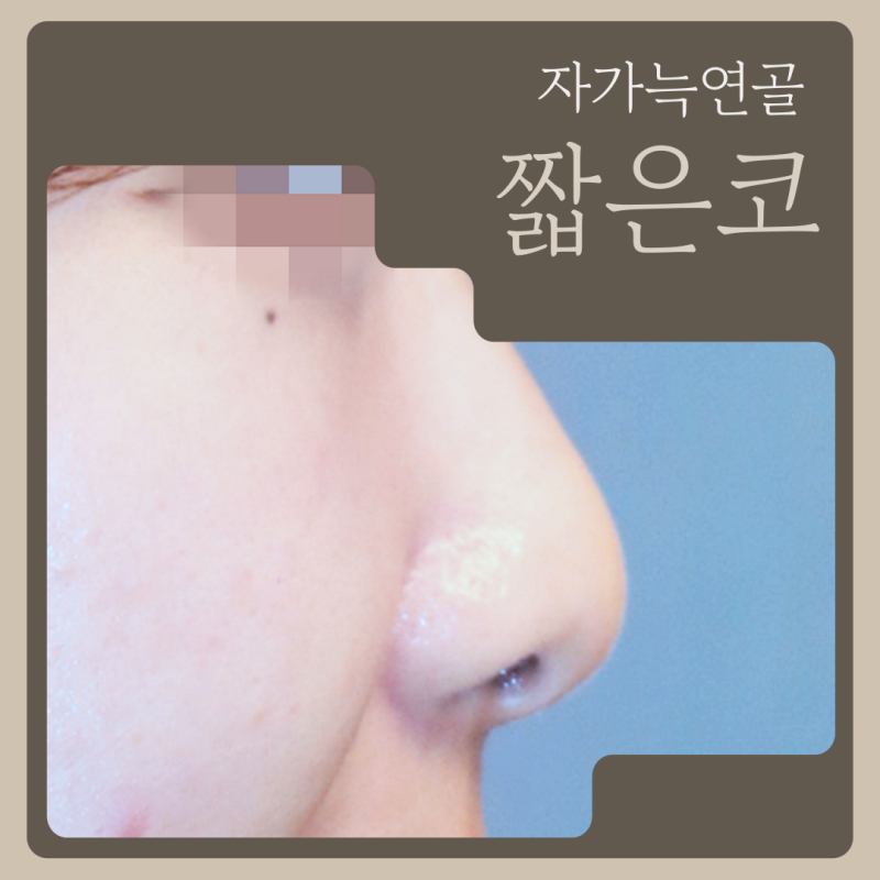 짧은코성형, 자가늑연골 기준