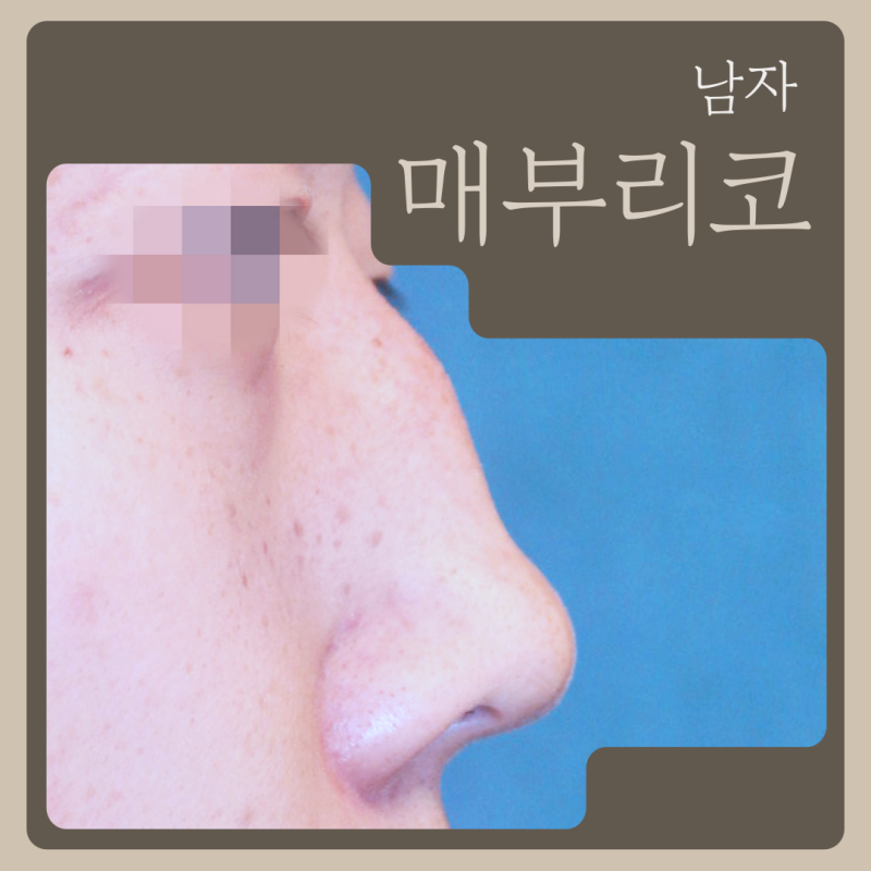 남자매부리코, 자가늑연골 개선 기준