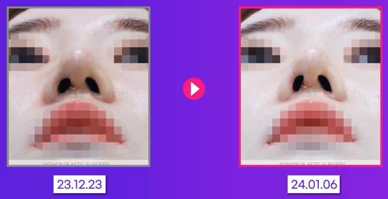 코실제거, 하이코제거, 단순 제거로는 충분하지 않을 수 있습니다 사진 4