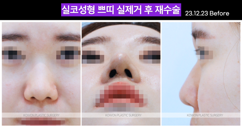 코실제거, 하이코제거, 단순 제거로는 충분하지 않을 수 있습니다 사진 3