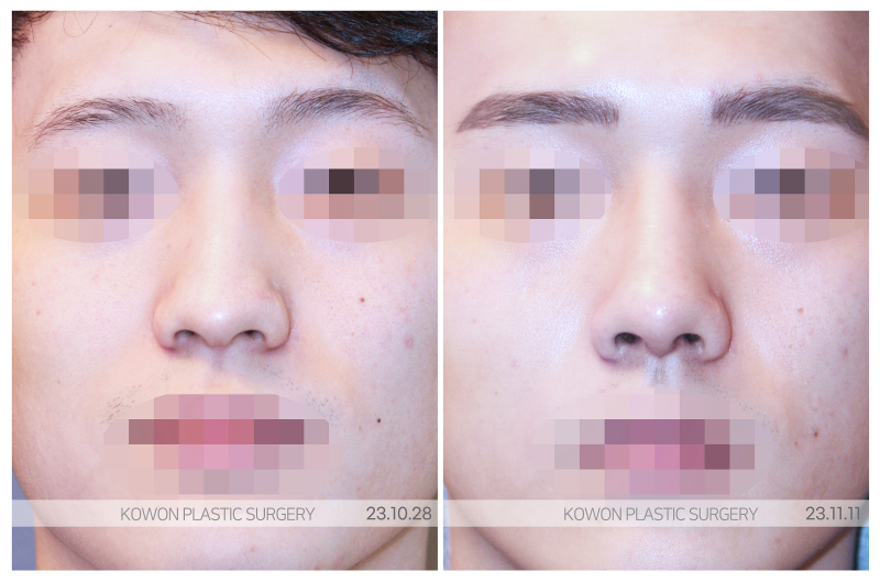 남자코성형잘하는곳, 리브핏 통해 자연스러운 라인 만들기 사진 3