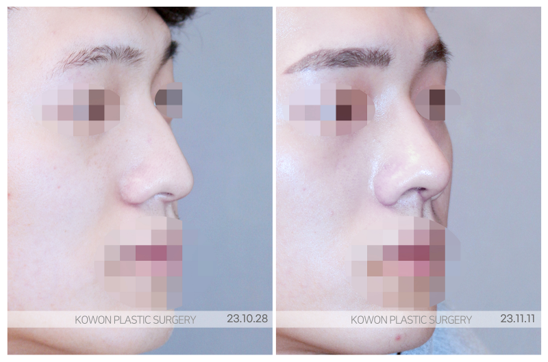 남자코성형잘하는곳, 리브핏 통해 자연스러운 라인 만들기 사진 5