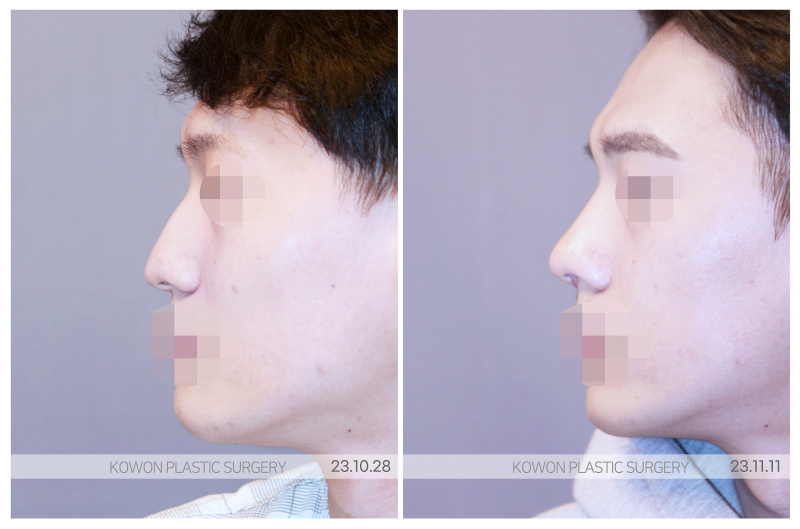남자코성형잘하는곳, 리브핏 통해 자연스러운 라인 만들기 사진 8