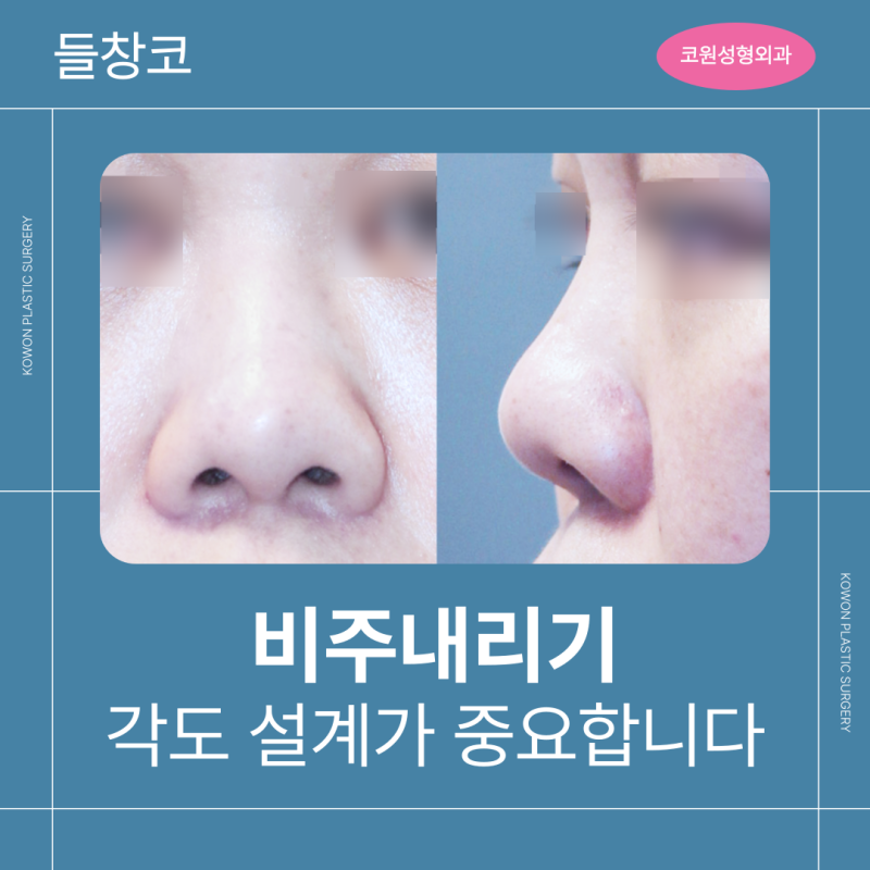 비주내리기, 들창코는 각도 설계가 결과를 좌우합니다