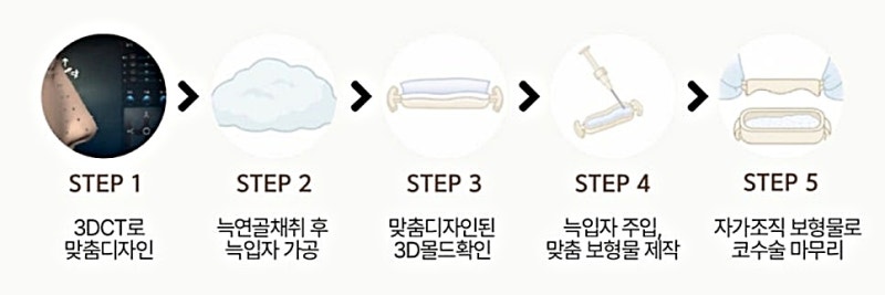코성형병원 선택 기준, 예쁜코를 만드는 재료 차이 사진 4