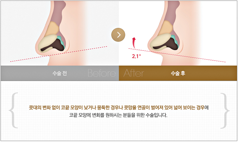 코끝묶기, 복코는 연골 구조부터 달라야 합니다 사진 4