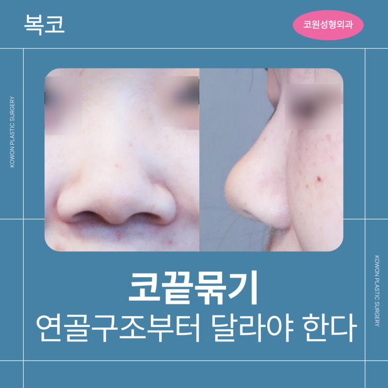 코끝묶기, 복코는 연골 구조부터 달라야 합니다
