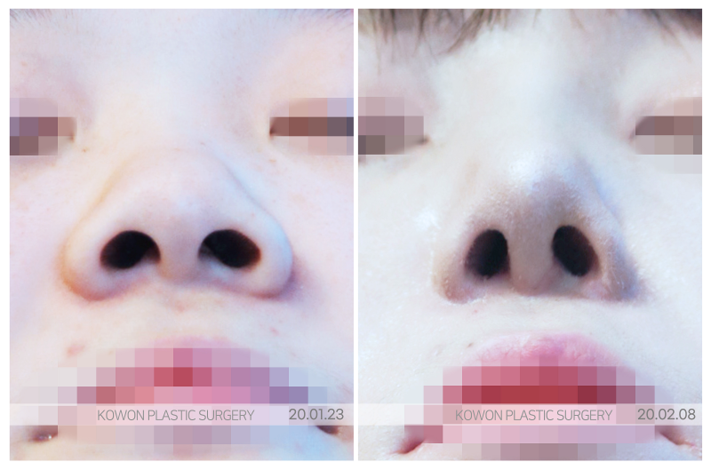 코끝묶기, 복코는 연골 구조부터 달라야 합니다 사진 5
