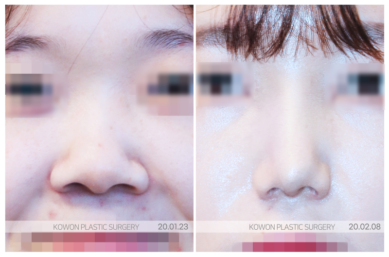 코끝묶기, 복코는 연골 구조부터 달라야 합니다 사진 3