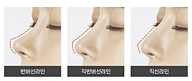 반버선코, 자가늑연골 선택은 얼굴 구조에서 갈립니다 사진 4