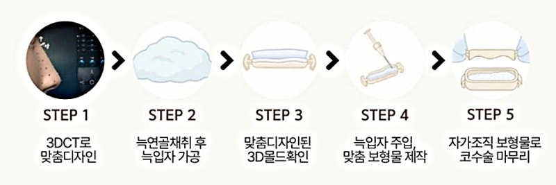 반버선코, 자가늑연골 선택은 얼굴 구조에서 갈립니다 사진 6