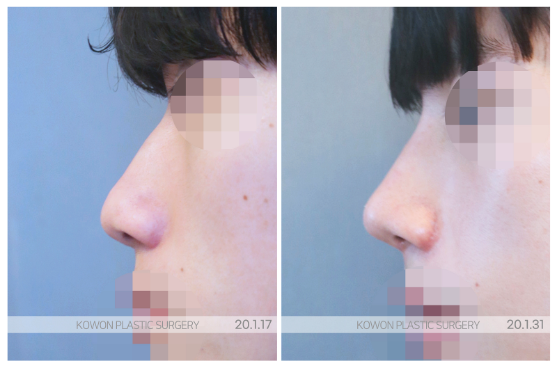 신사역 코성형외과, 남자코 상담 전 기준 정리 사진 5