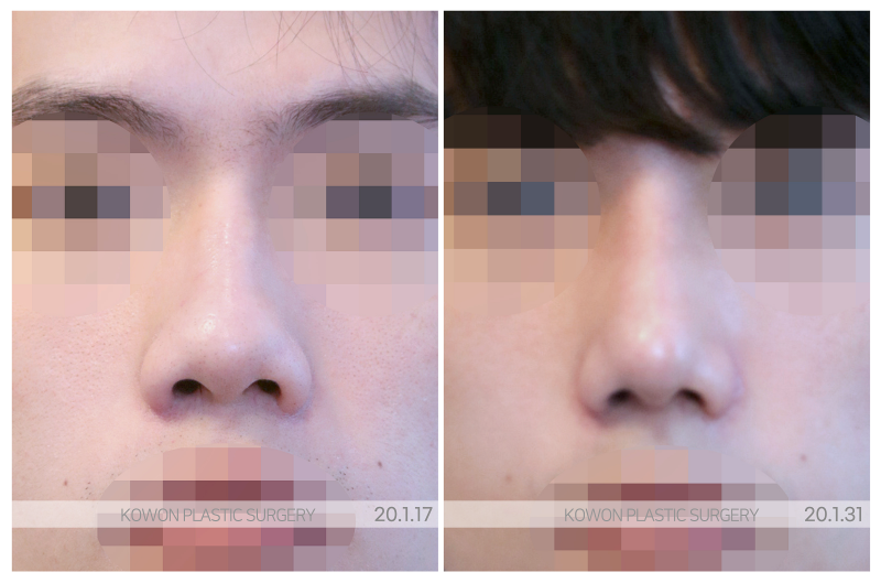 신사역 코성형외과, 남자코 상담 전 기준 정리 사진 3