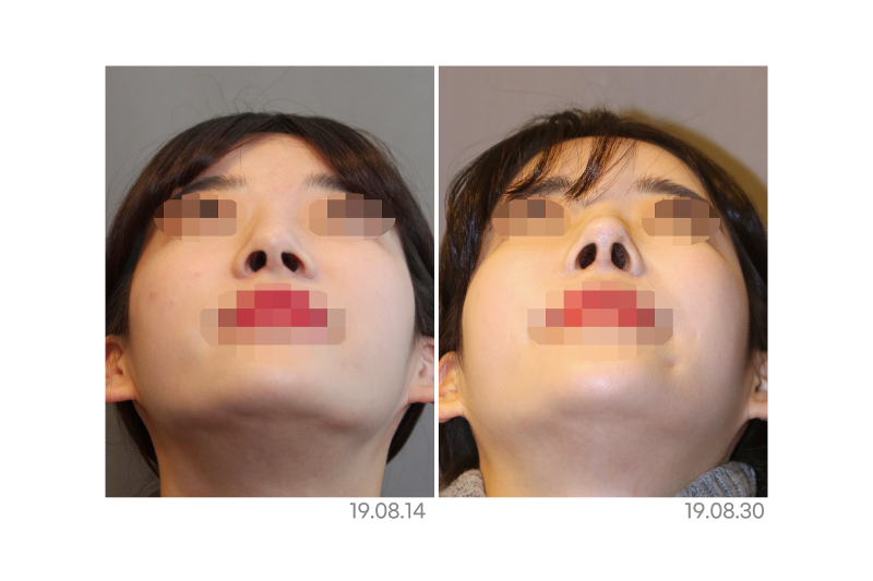 코재수술잘하는곳, 자가늑연골 선택 전 상담 기준 사진 4