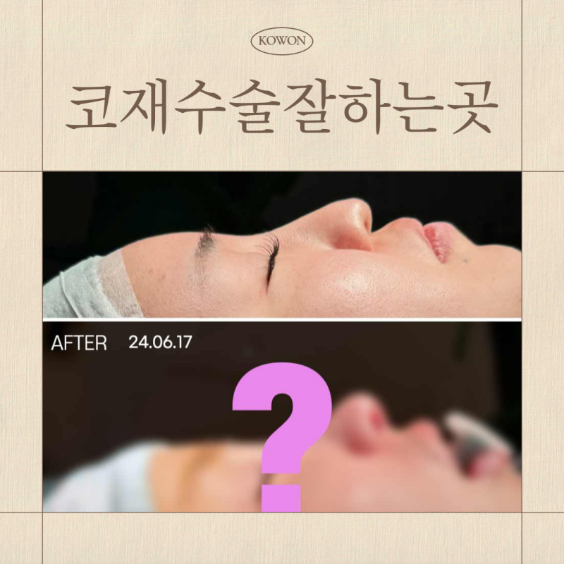 코재수술잘하는곳, 자가늑연골 선택 전 상담 기준