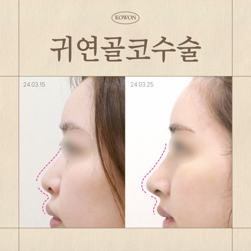 귀연골코수술, 코끝 모양과 지지력까지 모두 잡는 방법